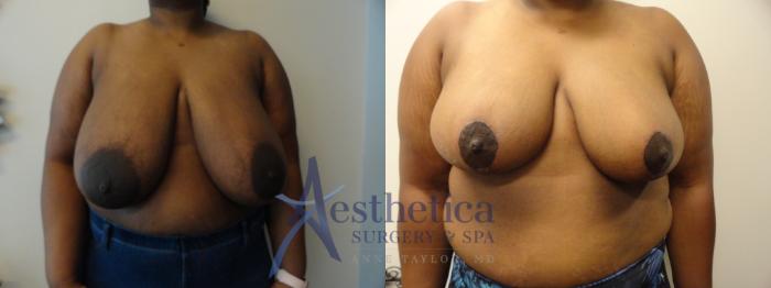 Breast Reduction Case 396 Before & After View #1 | Columbus, OH | Aesthetica Surgery & Spa