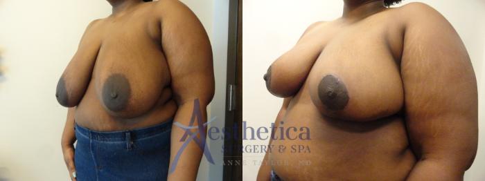 Breast Reduction Case 396 Before & After View #2 | Columbus, OH | Aesthetica Surgery & Spa