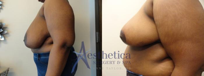Breast Reduction Case 396 Before & After View #3 | Columbus, OH | Aesthetica Surgery & Spa