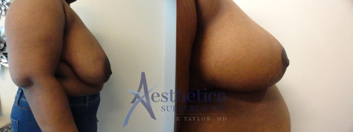 Breast Reduction Case 396 Before & After View #4 | Columbus, OH | Aesthetica Surgery & Spa