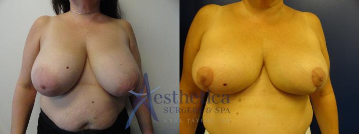 Breast Reduction Case 397 Before & After View #1 | Columbus, OH | Aesthetica Surgery & Spa
