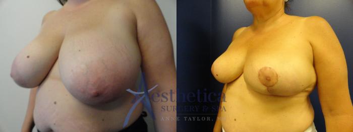 Breast Reduction Case 397 Before & After View #2 | Columbus, OH | Aesthetica Surgery & Spa