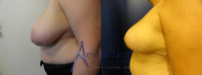 Breast Reduction Case 397 Before & After View #3 | Columbus, OH | Aesthetica Surgery & Spa