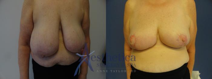 Breast Reduction Case 398 Before & After View #1 | Columbus, OH | Aesthetica Surgery & Spa