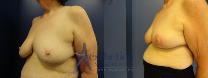 Breast Reduction Case 398 Before & After View #2 | Columbus, OH | Aesthetica Surgery & Spa