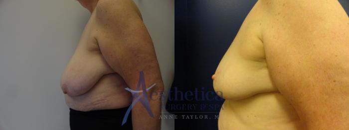 Breast Reduction Case 398 Before & After View #3 | Columbus, OH | Aesthetica Surgery & Spa