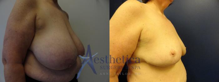 Breast Reduction Case 398 Before & After View #4 | Columbus, OH | Aesthetica Surgery & Spa