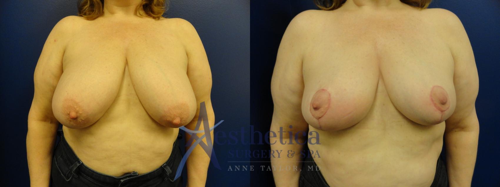 Breast Reduction Case 399 Before & After View #1 | Columbus, OH | Aesthetica Surgery & Spa