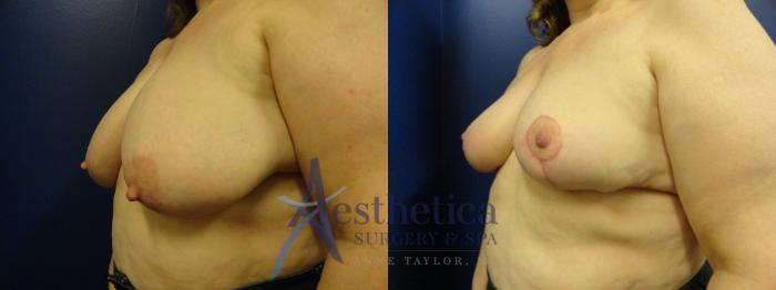 Breast Reduction Case 399 Before & After View #2 | Columbus, OH | Aesthetica Surgery & Spa