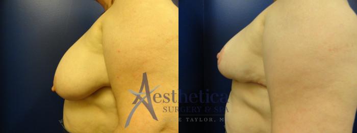 Breast Reduction Case 399 Before & After View #3 | Columbus, OH | Aesthetica Surgery & Spa