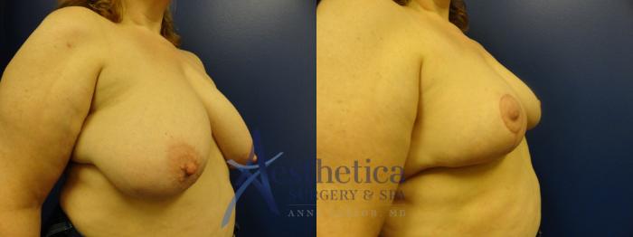 Breast Reduction Case 399 Before & After View #4 | Columbus, OH | Aesthetica Surgery & Spa
