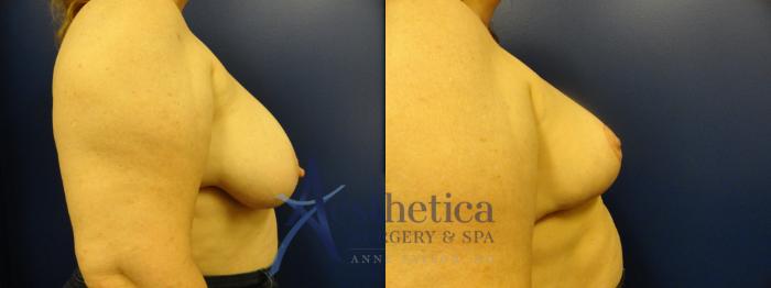Breast Reduction Case 399 Before & After View #5 | Columbus, OH | Aesthetica Surgery & Spa
