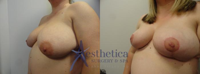 Breast Reduction Case 400 Before & After View #2 | Columbus, OH | Aesthetica Surgery & Spa
