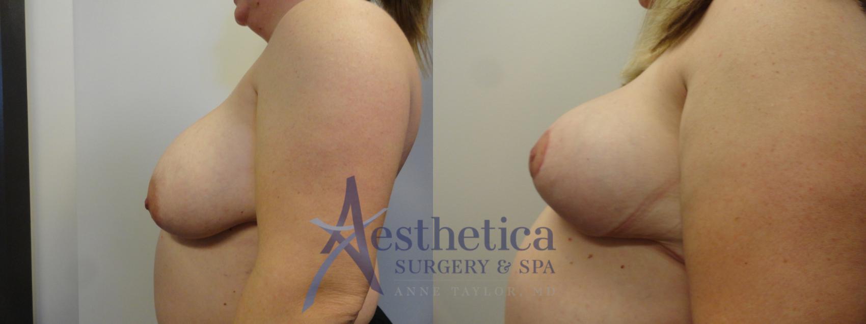 Breast Reduction Case 400 Before & After View #3 | Columbus, OH | Aesthetica Surgery & Spa