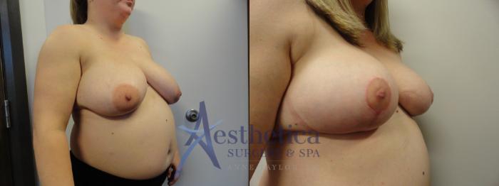 Breast Reduction Case 400 Before & After View #4 | Columbus, OH | Aesthetica Surgery & Spa