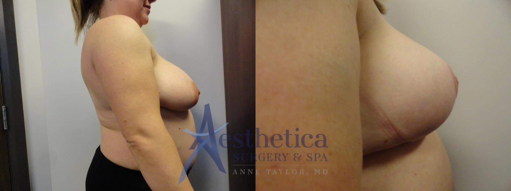Breast Reduction Case 400 Before & After View #5 | Columbus, OH | Aesthetica Surgery & Spa