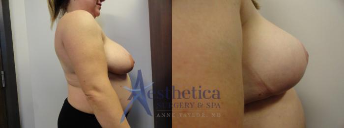 Breast Reduction Case 400 Before & After View #5 | Columbus, OH | Aesthetica Surgery & Spa