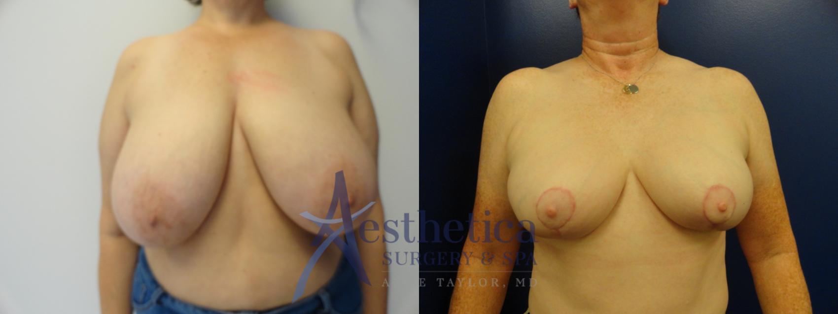 Breast Reduction Case 401 Before & After View #1 | Columbus, OH | Aesthetica Surgery & Spa
