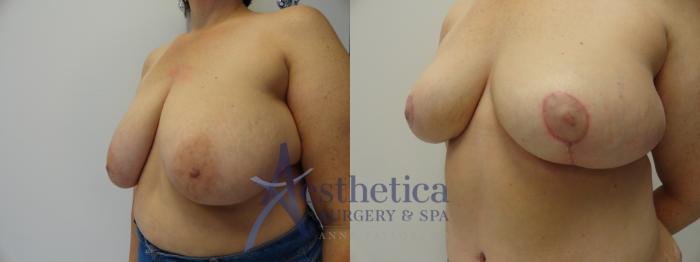 Breast Reduction Case 401 Before & After View #2 | Columbus, OH | Aesthetica Surgery & Spa
