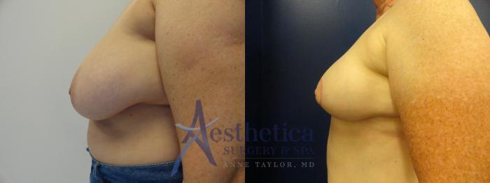 Breast Reduction Case 401 Before & After View #3 | Columbus, OH | Aesthetica Surgery & Spa