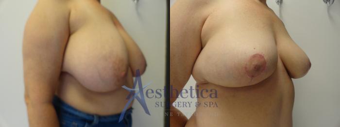 Breast Reduction Case 401 Before & After View #4 | Columbus, OH | Aesthetica Surgery & Spa
