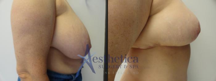 Breast Reduction Case 401 Before & After View #5 | Columbus, OH | Aesthetica Surgery & Spa