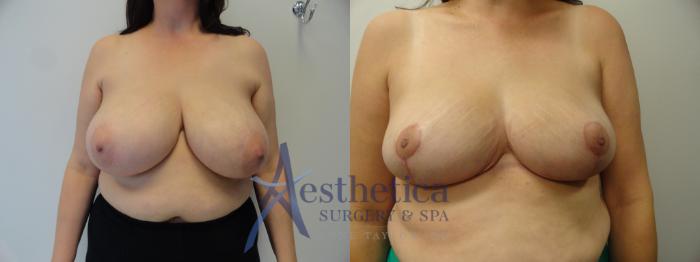 Breast Reduction Case 402 Before & After View #1 | Columbus, OH | Aesthetica Surgery & Spa
