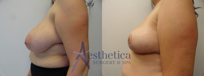Breast Reduction Case 402 Before & After View #3 | Columbus, OH | Aesthetica Surgery & Spa