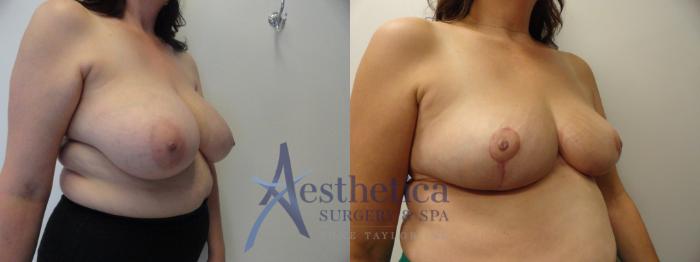Breast Reduction Case 402 Before & After View #4 | Columbus, OH | Aesthetica Surgery & Spa
