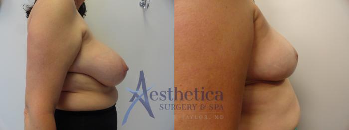 Breast Reduction Case 402 Before & After View #5 | Columbus, OH | Aesthetica Surgery & Spa