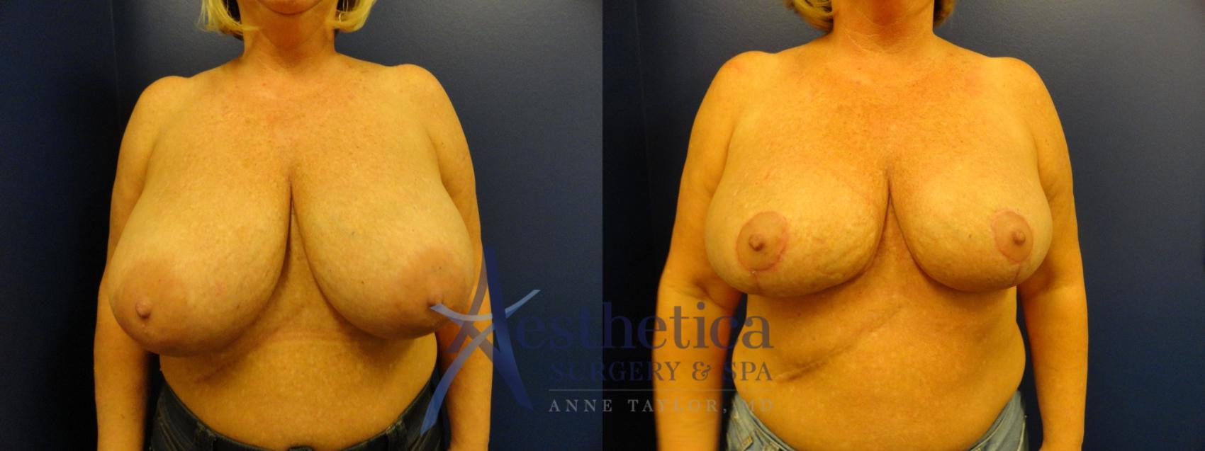 Breast Reduction Case 403 Before & After View #1 | Columbus, OH | Aesthetica Surgery & Spa