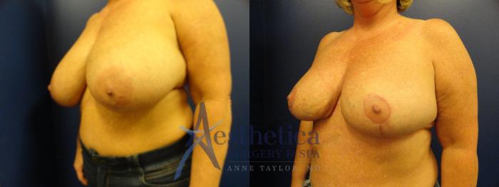 Breast Reduction Case 403 Before & After View #2 | Columbus, OH | Aesthetica Surgery & Spa