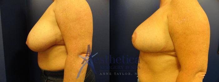 Breast Reduction Case 403 Before & After View #3 | Columbus, OH | Aesthetica Surgery & Spa