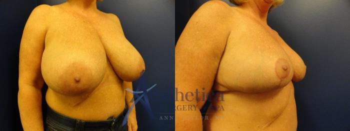 Breast Reduction Case 403 Before & After View #4 | Columbus, OH | Aesthetica Surgery & Spa
