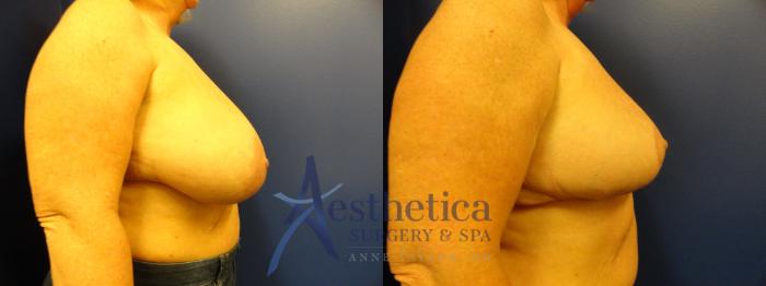 Breast Reduction Case 403 Before & After View #5 | Columbus, OH | Aesthetica Surgery & Spa