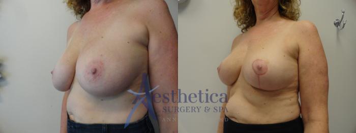 Breast Reduction Case 404 Before & After View #2 | Columbus, OH | Aesthetica Surgery & Spa