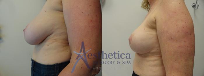 Breast Reduction Case 404 Before & After View #3 | Columbus, OH | Aesthetica Surgery & Spa