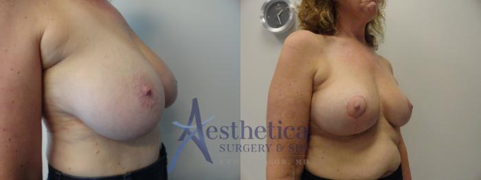 Breast Reduction Case 404 Before & After View #4 | Columbus, OH | Aesthetica Surgery & Spa