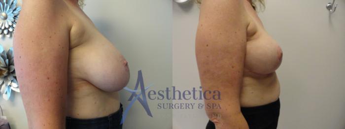 Breast Reduction Case 404 Before & After View #5 | Columbus, OH | Aesthetica Surgery & Spa