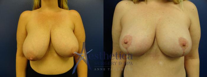 Breast Reduction Case 405 Before & After View #1 | Columbus, OH | Aesthetica Surgery & Spa