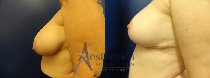 Breast Reduction Case 405 Before & After View #2 | Columbus, OH | Aesthetica Surgery & Spa