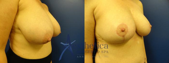 Breast Reduction Case 405 Before & After View #3 | Columbus, OH | Aesthetica Surgery & Spa