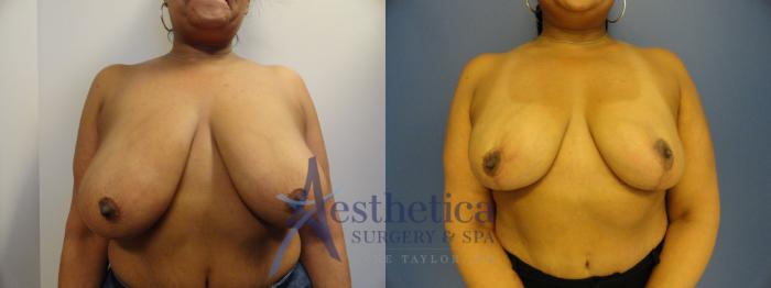 Breast Reduction Case 406 Before & After View #1 | Columbus, OH | Aesthetica Surgery & Spa