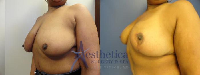 Breast Reduction Case 406 Before & After View #2 | Columbus, OH | Aesthetica Surgery & Spa