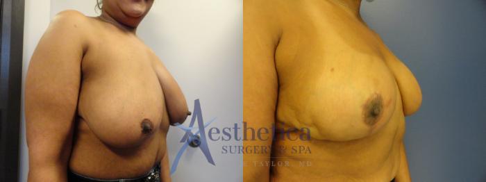 Breast Reduction Case 406 Before & After View #3 | Columbus, OH | Aesthetica Surgery & Spa