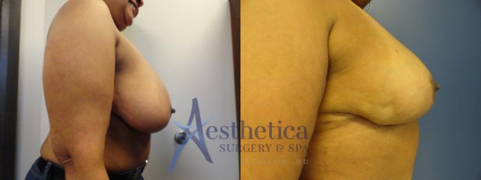 Breast Reduction Case 406 Before & After View #4 | Columbus, OH | Aesthetica Surgery & Spa