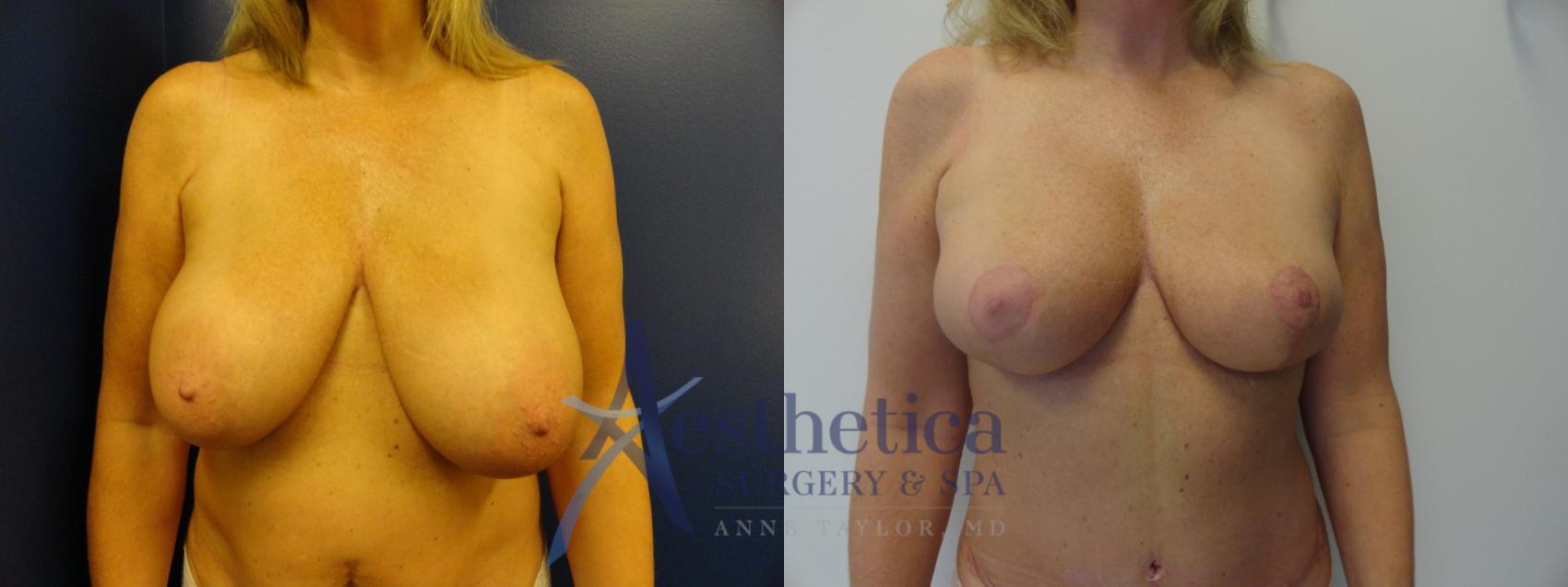 Breast Reduction Case 407 Before & After View #1 | Columbus, OH | Aesthetica Surgery & Spa