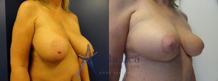 Breast Reduction Case 407 Before & After View #2 | Columbus, OH | Aesthetica Surgery & Spa