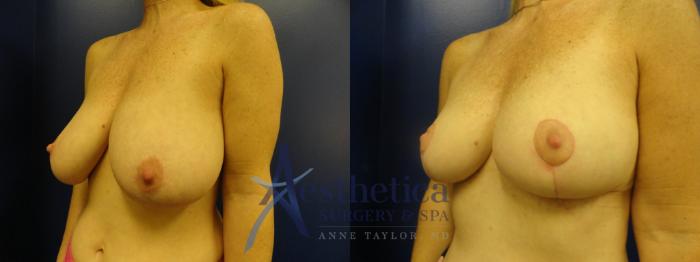 Breast Reduction Case 408 Before & After View #2 | Columbus, OH | Aesthetica Surgery & Spa