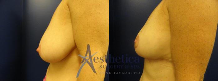 Breast Reduction Case 408 Before & After View #3 | Columbus, OH | Aesthetica Surgery & Spa
